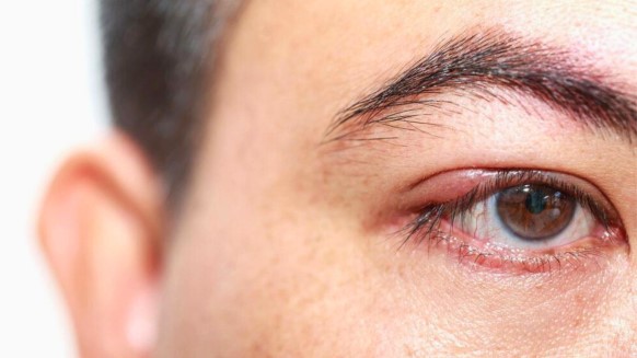Blepharitis
