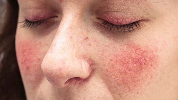 Ocular Rosacea