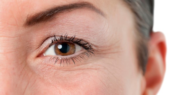 Post-Blepharoplasty