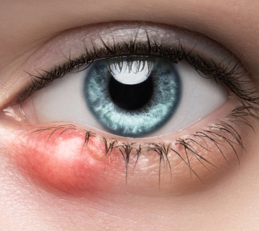 Stye and Chalazion Treatment