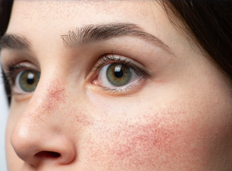 rosacea
