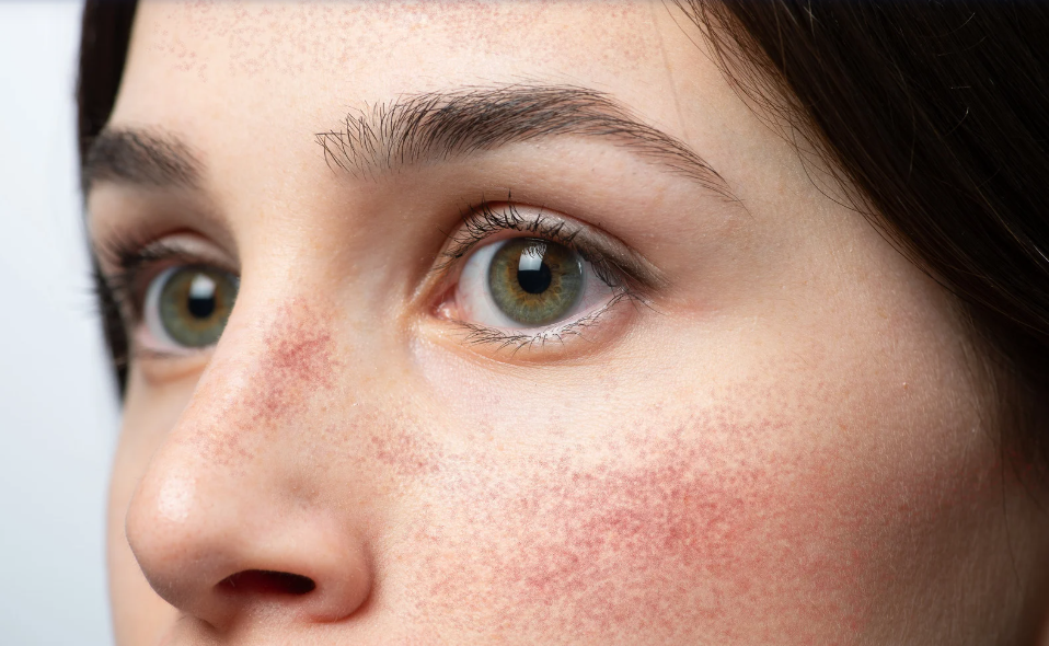 rosacea