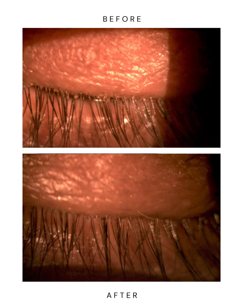 dry eye