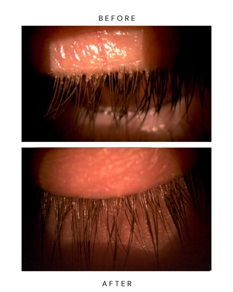 chalazion